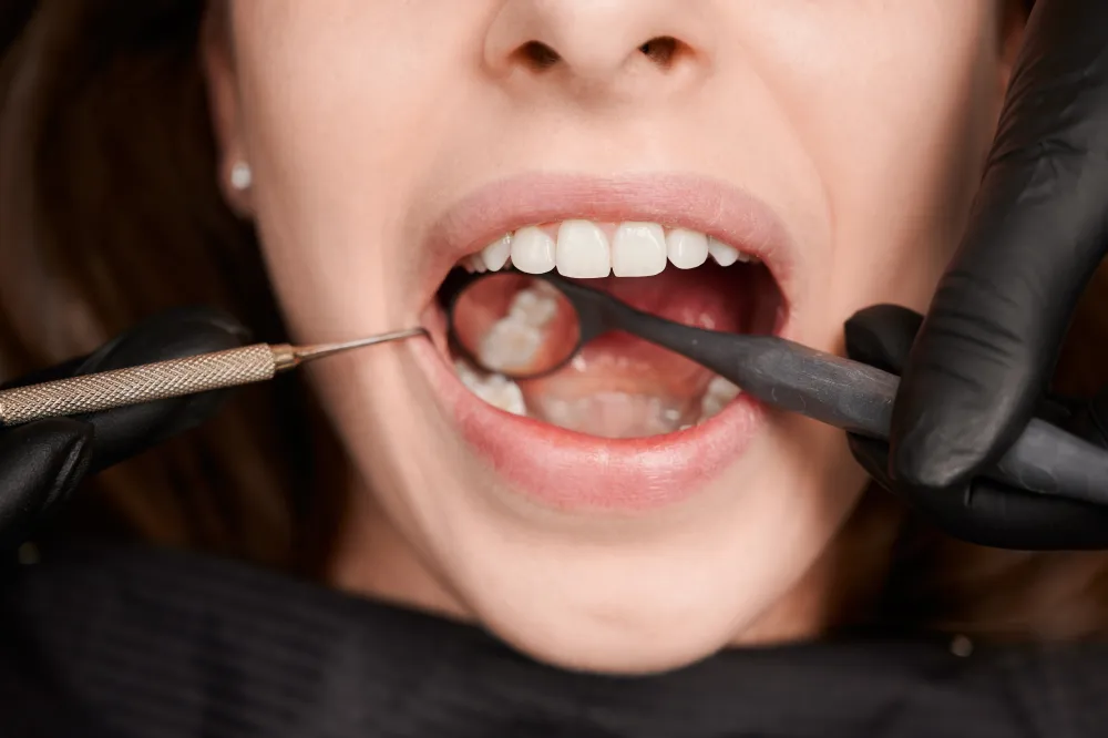 Best Dental Veneers in Coimbatore