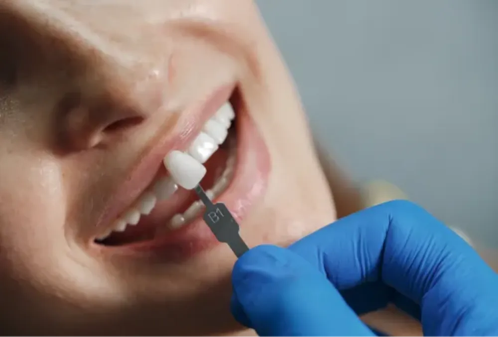 Dental Filling