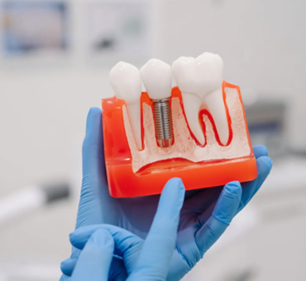 Dental Implants