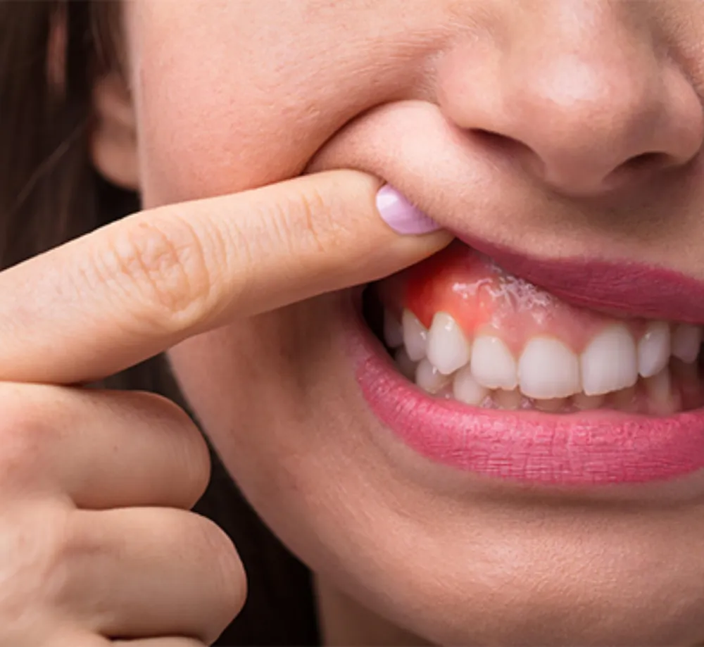 Gum Treatment in Coimbatore