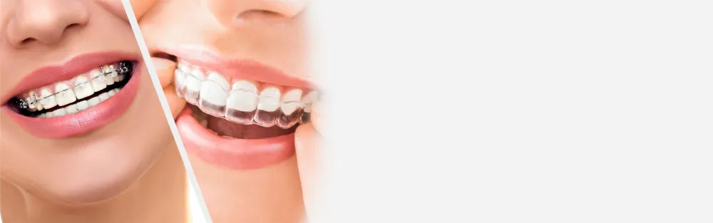 Invisalign