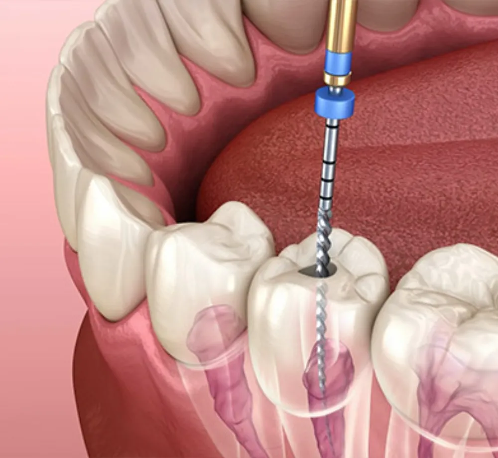 Root Canal Treatment