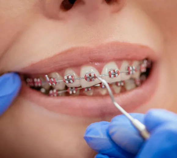 dental braces for crowded teeth