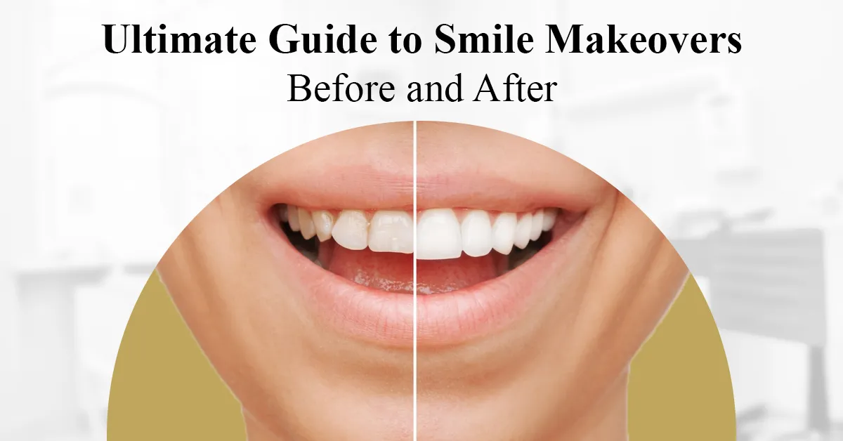 ultimate guide to smile makeovers: before and after