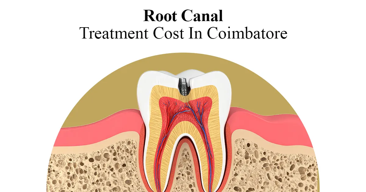 root canal near me
