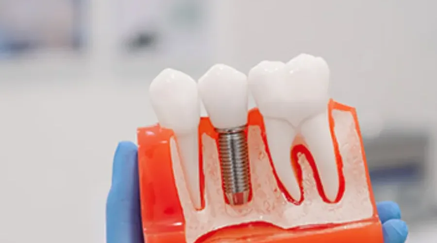 Dental Implant Aftercare: A Week-by-Week Recovery Guide