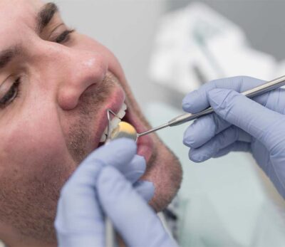 Tooth Crown & Dental Bridges