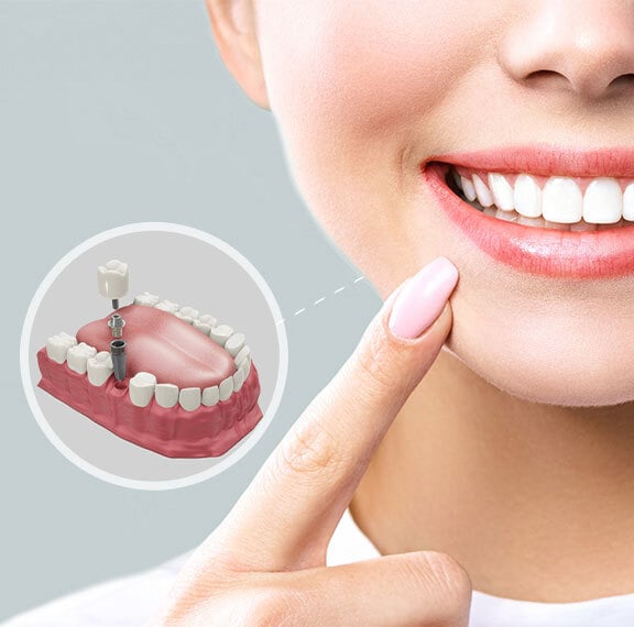 Dental implant cost in Coimbatore