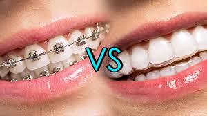 Best-Invisible-Braces-Service-Doctors-In-Coimbatore