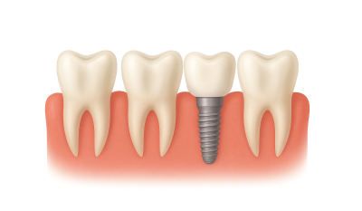 Endosteal dental Implants