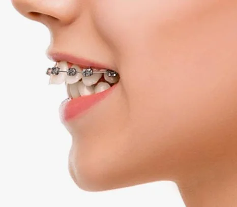 Jaw Correction