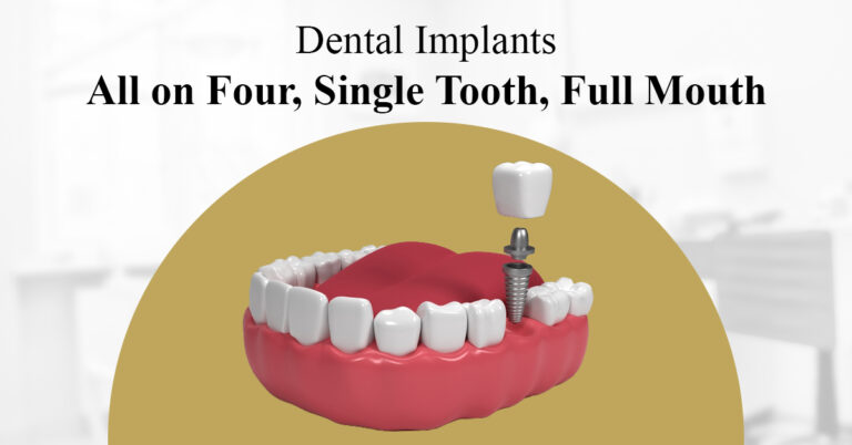 dental implants: all on four, single tooth, full mouth
