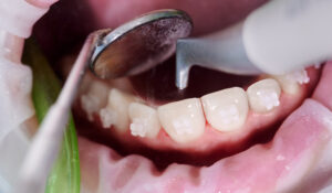 Close-up picture of a woman’s mouth during dental procedure of cleaning teeth