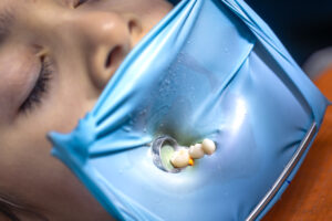 The dentist treats the child’s tooth using a rubber dam. Close-up of tooth treatment.